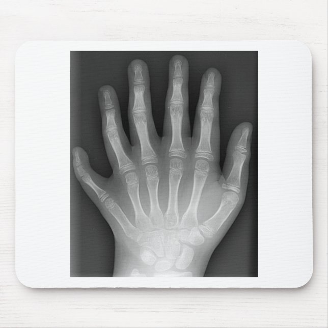 Mousepad Polydactyly, seis mãos apontado, raio X, raridade! (Frente)