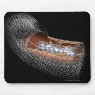 Mousepad Vista de um balão angioplaty em uma artéria