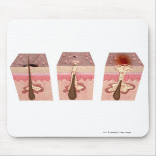 Mousepad Vista do que causa a acne