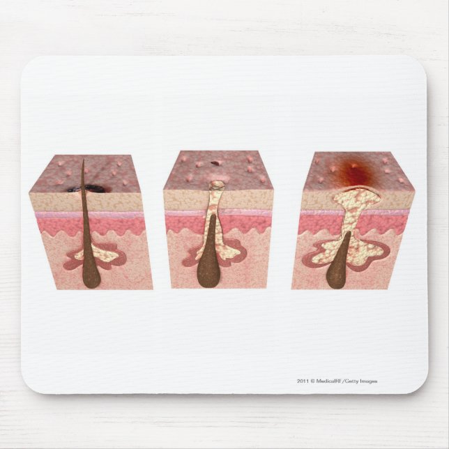 Mousepad Vista do que causa a acne (Frente)