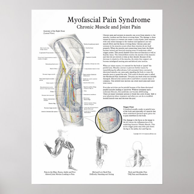 Myofascial Pain Syndrome Poster (Frente)