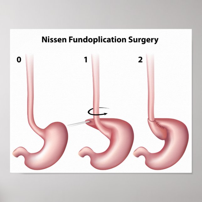 Nissen Poster de cirurgia de estômago de Fundoplic (Frente)