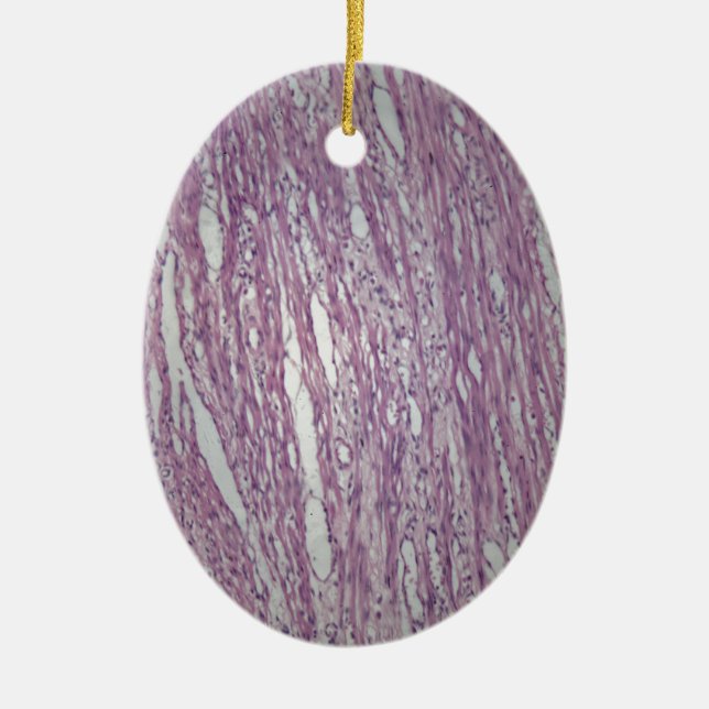 Ornamento De Cerâmica Pilhas do tecido humano do útero com tumo (Frente)