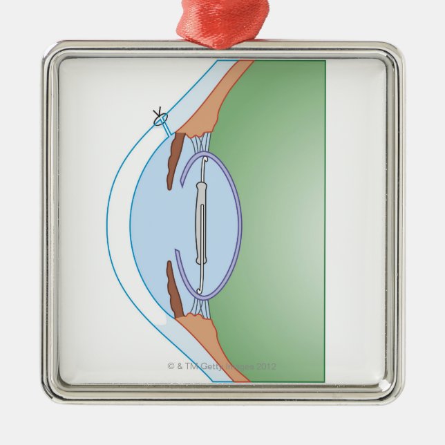 Ornamento De Metal Cirurgia da catarata (Frente)