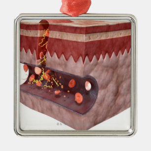 Ornamento De Metal Formação do coágulo de sangue