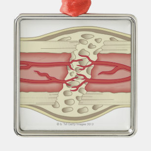 Ornamento De Metal Osso que repara-se 2