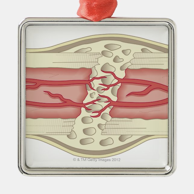 Ornamento De Metal Osso que repara-se 2 (Frente)