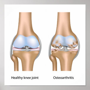 Osteoartrite Poster da articulação do joelho