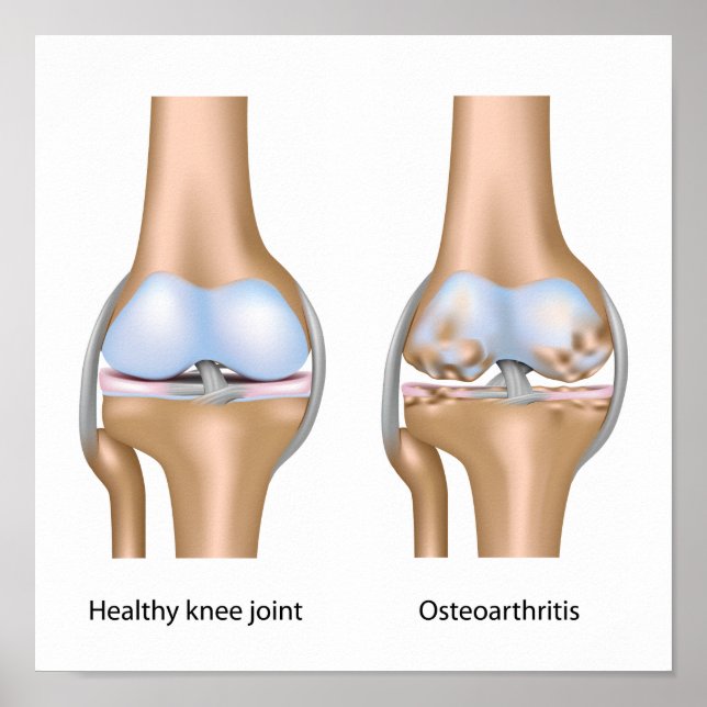 Osteoartrite Poster da articulação do joelho (Frente)