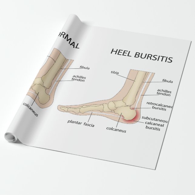 Papel De Presente Deformidade de Haglund (Desenrolado)