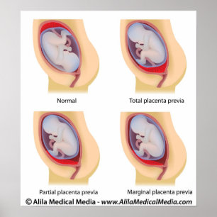 Placenta - poster prévia