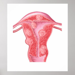 Pôster Anatomia de tumores fibroides no útero fêmea