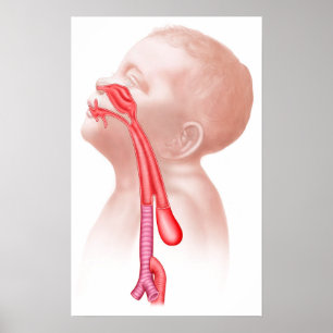 Pôster Anatomia de uma fístula Tracheoesophageal