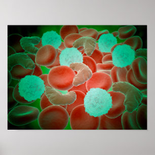 Pôster Anemia da célula falciforme com glóbulos vermelh