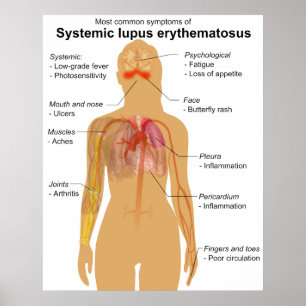 Poster Carta do sintoma de Erythematosus de lúpus