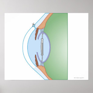 Pôster Cirurgia da catarata