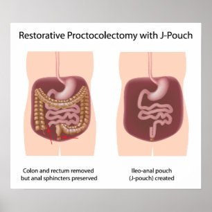 Pôster Cirurgia de proctocolectomia reativa com j-pouch