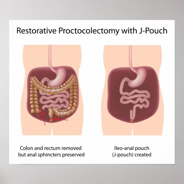 Pôster Cirurgia de proctocolectomia reativa com j-pouch (Frente)