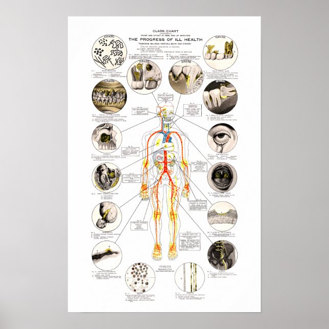 Poster Clark Dental Health Chart for Dentist (Frente)