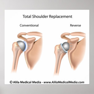 Poster Conventional vs reverse total shoulder replacement