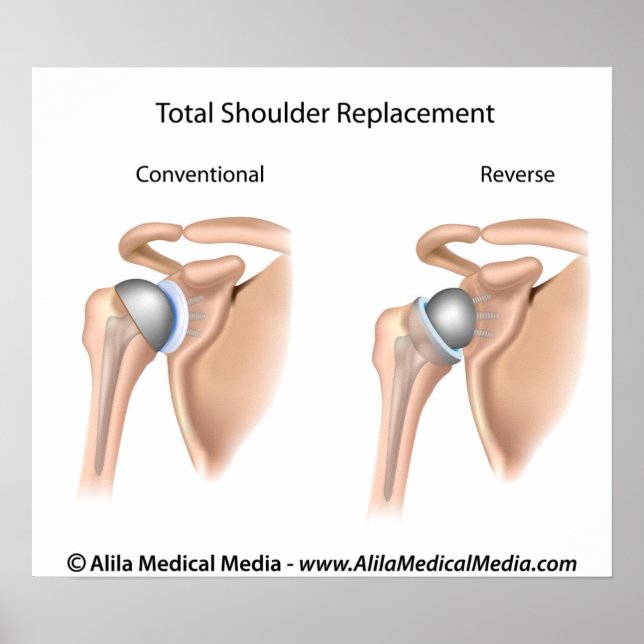 Poster Conventional vs reverse total shoulder replacement (Frente)