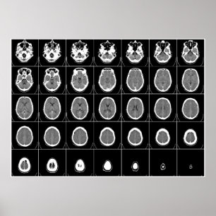 PÔSTER CT VERIFICAÇÃO DA CABEÇA