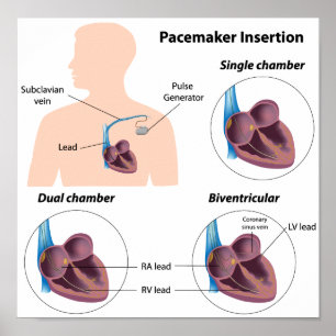 Poster da cirurgia da inserção do pacemaker