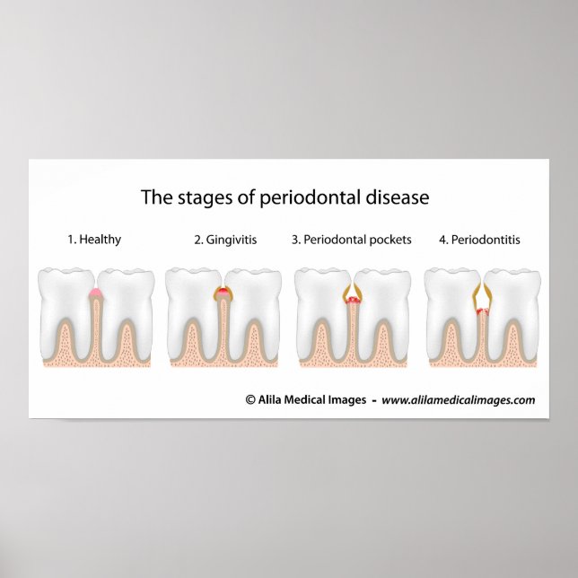 Poster da Doença Periodontal dos dentes (Frente)