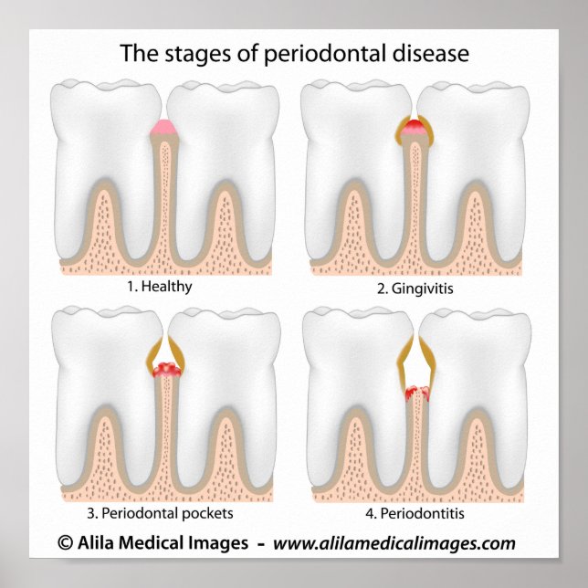 Poster da Doença Periodontal dos dentes (Frente)