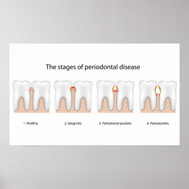 Poster da Doença Periodontal dos dentes (Frente)