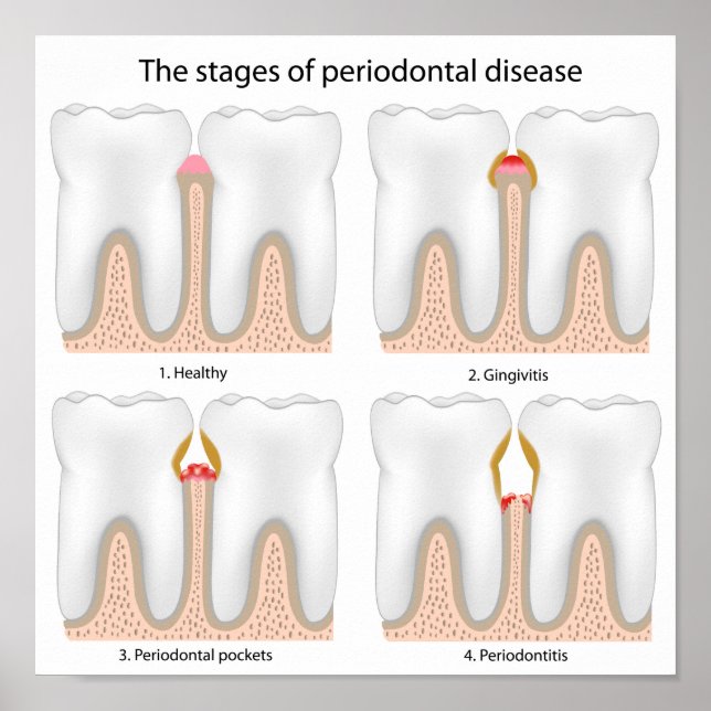 Poster da Doença Periodontal dos dentes (Frente)