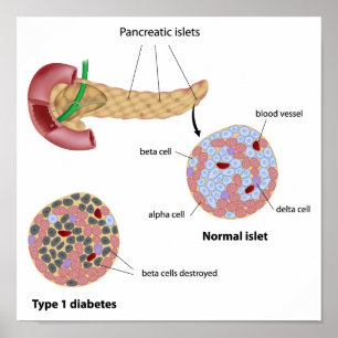 Poster da ilhota pancreático e do diabetes