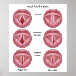 Poster da paralisia do cabo vocal