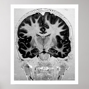 POSTER de cabeça de MRI