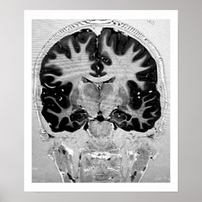 POSTER de cabeça de MRI (Frente)