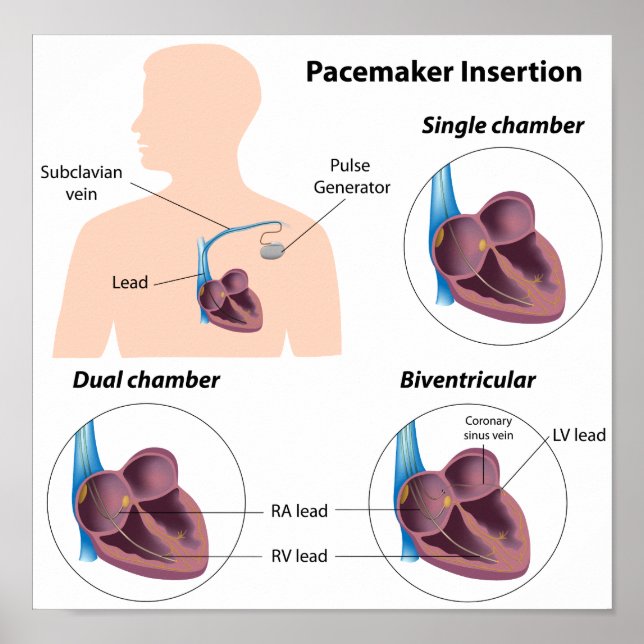 Poster de cirurgia de inserção de pacemaker (Frente)