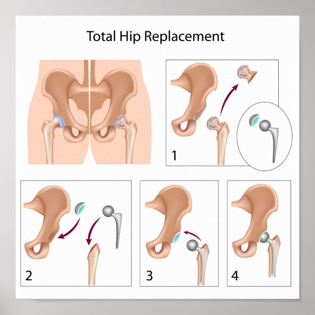Poster de cirurgia de substituição total da anca (Frente)