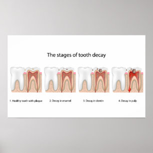 Poster de decaimento dos dentes