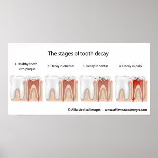 Poster de decaimento dos dentes