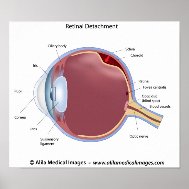 Poster de descolamento da retina ocular (Frente)