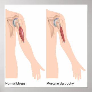 Poster de distrofia muscular