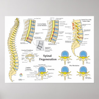 Poster de Herniação de Disco de Degeneração da Esp