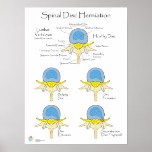 Poster de Hernição de Disco Spinal Poster Médico