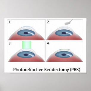 Poster de Keratectomia Fotorefrativa (PRK)