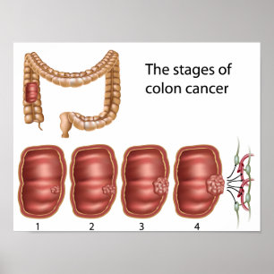 Poster de progressão do cancer de dois pontos
