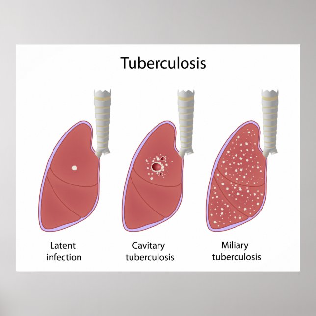 Poster de tipos de tuberculose (Frente)