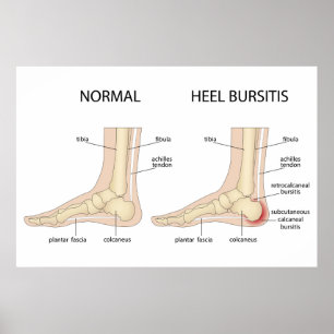 Poster Deformidade de Haglund