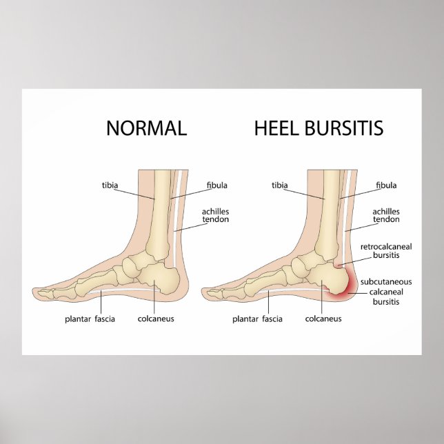 Poster Deformidade de Haglund (Frente)