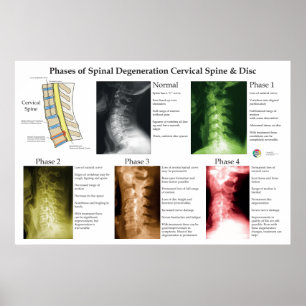 Poster Degeneração Espinhal Coluna Cervical Quiropraxia
