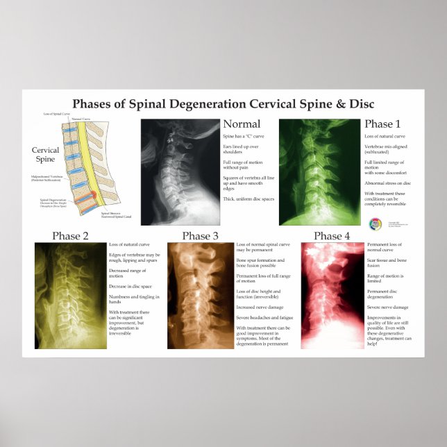 Poster Degeneração Espinhal Coluna Cervical Quiropraxia (Frente)